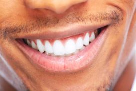 Can i have my teeth whitened with veneers